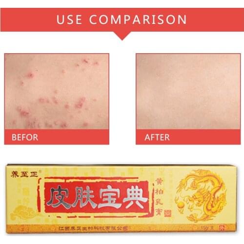 Dropshipping YIGANERJING Skin Psoriasis Cream Dermatitis Eczematoid Eczema Ointment Treatment Psoriasis Cream Skin Care Cream