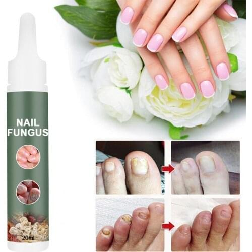 20ml Nail Fungus Cream Effective Nourishing Nails Portable Onychomycosis Treatment Ointment for Unisex