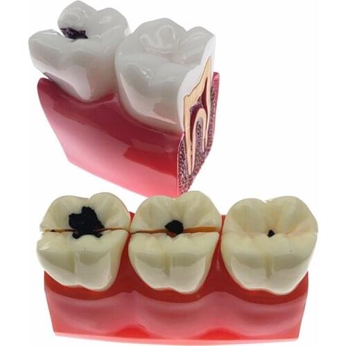 Teeth Model Caries Comparation Study Models 4Times/6times Caries model Teaching research model for dentistry students