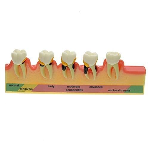 High Quality Dental Periodontal Disease Assort Tooth Typodont Model Free Shipping