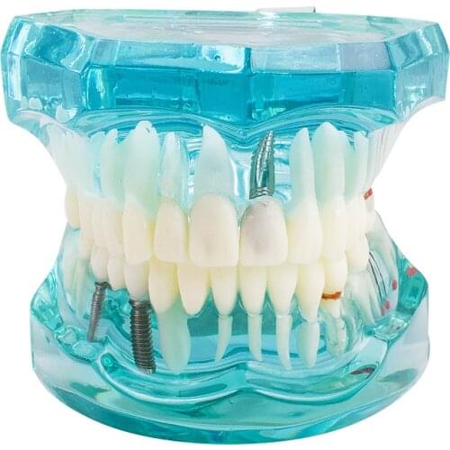 Light blue Promotion Dental Study Tooth Transparent Adult Pathological Teeth Model Dental Lab Equipment Dentist Teaching