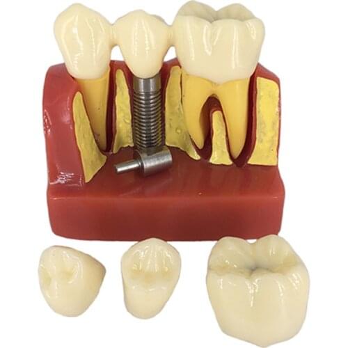 Clear / Red Dental Implant Teeth Model Dentist Standard Disease Removable Tooth Pathological Teaching Model Disease Teeth Model
