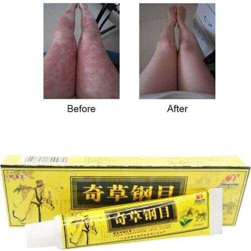 Advanced Body Psoriasis Cream For Dermatitis and Eczema Pruritus Psoriasis Ointment Herbal Creams
