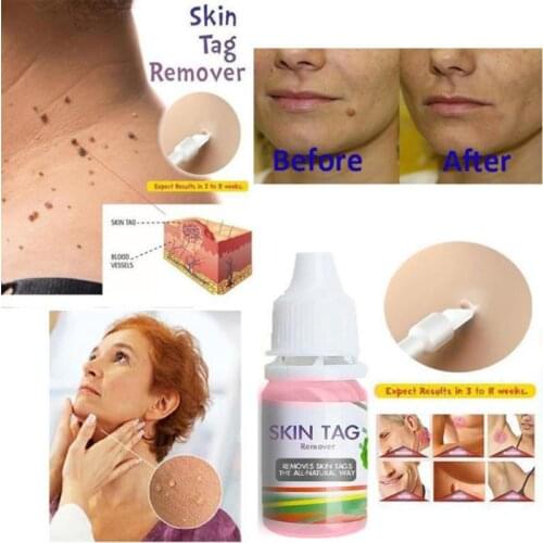 10ml Skin Tag Remover Liquid Natural Plant Extract Foot Corn Plantar Body Warts Chinese Medicine Treatment Ointment