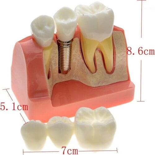 Free Shipping 2016 New Sale Dental Demonstration Teeth Model Implant Analysis Crown Bridge