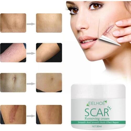 Hot Removal Scar Cream Face Pimples Scar Stretch Marks Treatment Skin Whitening Moisturizing Cream Removal Acne Care Y2S5