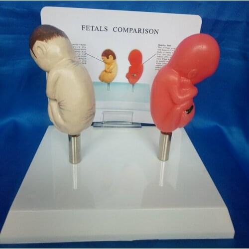 Smoking Fetus and Normal Fetus Comparison Model Smoking Pathological Fetal Model Medical Teaching Model Smoking Baby Comparison