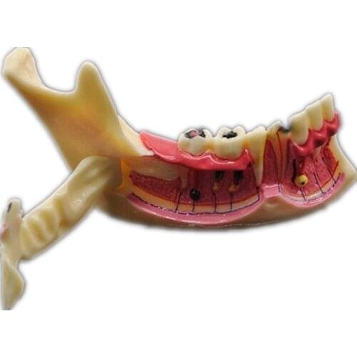 Dental Endodontic Treatment Model Anatomy of gums Dental Study Teach Teeth Model
