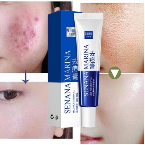 Okenys Anti Acne Pimple Cream Repair Acne Scars Anti Inflammatory Face Beauty Smooth Skin Care Oil Control Vera Aloe Gel