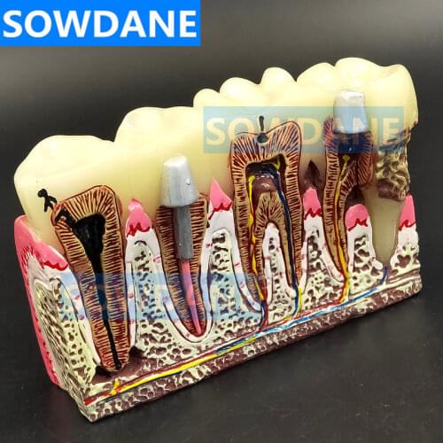 Dental Teeth Common Pathologies Model Teaching Model Tooth Dentist for Medical Science Teaching Dental Communication Model