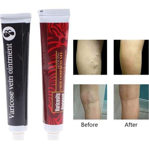 Varicose Veins Treatment Cream Effective cure Vasculitis Phlebitis Spider Veins Pain Varicosity Angiitis ointment Health Care