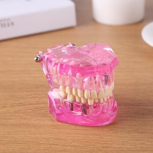 Dental Orthodontic Model Resin Oral Teeth Model for Oral Health Medical Teaching