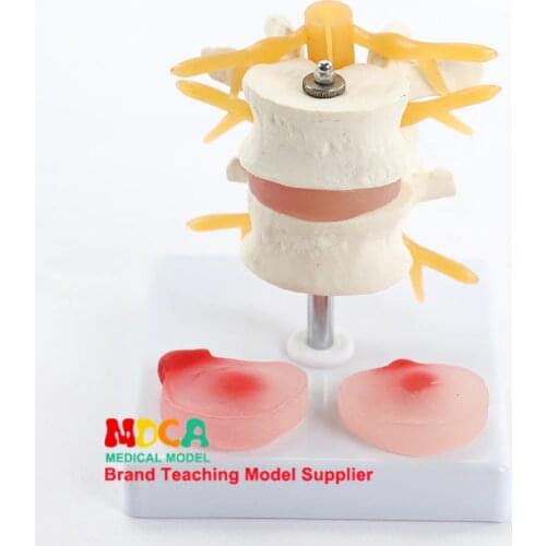 Two lumbar lesions, intervertebral disc, human.skeleton spine model, medical teaching MYZ001