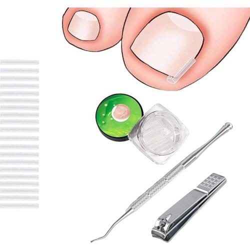 1set Ingrown Nail Pad Orthopedic Correction Treatment Kit Straightener Strips Recover Clips Sleeve Card Slot Correction Pad 2021