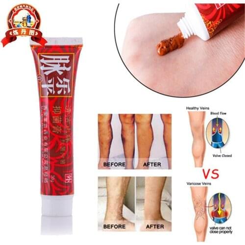Varicose Veins Treatment Cream Ointment Vasculitis Phlebitis Spider Veins Pain Varicosity Angiitis Remedy Removal Herbal Cream
