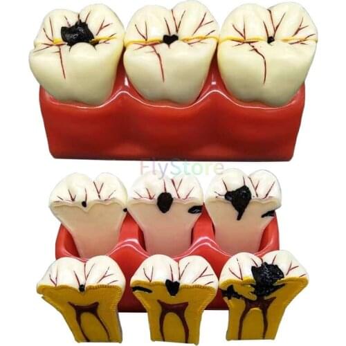 Dental Caries Decomposition Model Oral teaching Model patient communication Dissected Caries Model Dental Tooth Model