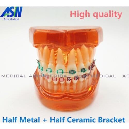 Teeth model With metal & ceramic brackets Irregular tooth Ortho Metal dentist patient student learning model