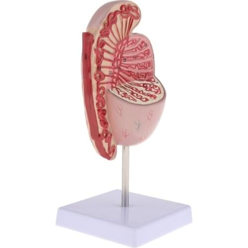 Life Size Human Kidney Diseased Model Anatomical Anatomy Diseased Pathological Stone Organ Teaching Supplies