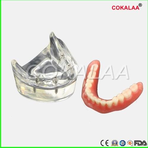 Dental Teeth Study Model Overdenture Inferior Implant Demo Model
