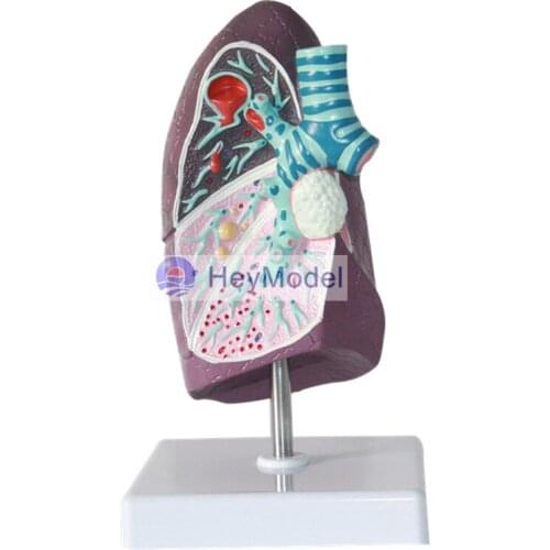 HeyModel Lung Lesions Medical human lung model smoker pulmonary