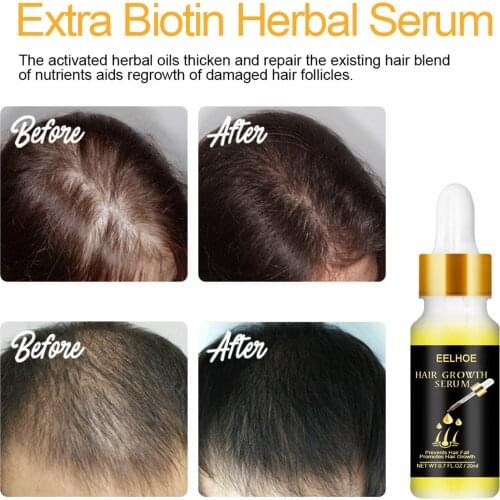 20ml Hair Care Hair Growth Essential Oils Essence Ginger Prevent Hair Loss Liquid Care Beauty Dense Hair Growth Serum