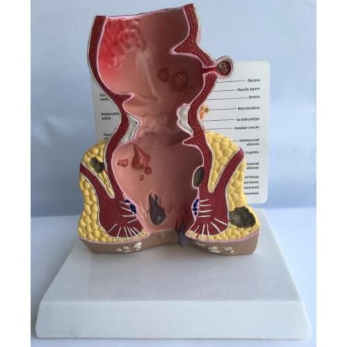 Diseases of the Colon & Rectum human anorectal pathology model, rectum, anal fistula, fissure lesion model