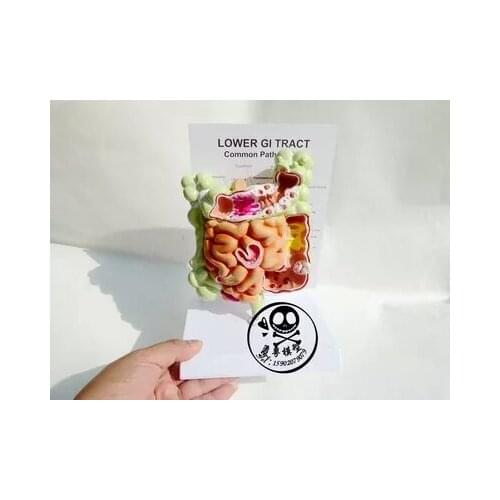 Human internal organs model Digestive system Colorectal pathology intestinal pathological changes Visceral structure free shippi