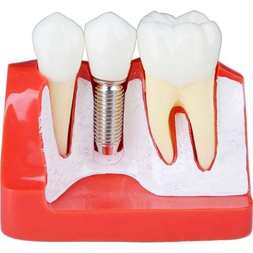 4 Times Teeth Model Dental Implant Analysis Crown Bridge Demonstration Dental Teeth Model Dentist Tools Study Model