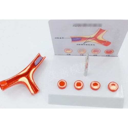 Human branch arterial infarction Cardiovascular artery infarction model Thrombus/formation model Blood vessel model
