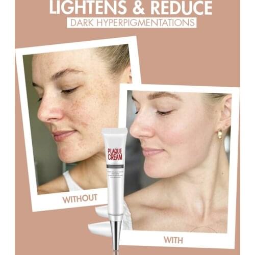Plaque Whitening Freckle Cream Remove Melasma Acne Spot Pigment Melanin Dark Spots Moisturizing Gel Face Skin Care TSLM2
