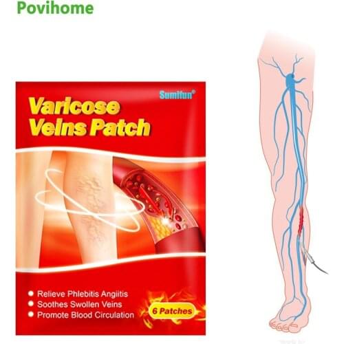 18pcs Sumifun Chinese Varicose Veins Plaster Vasculitis Phlebitis Spider Leg Medical Patch Angiitis Removal Patches