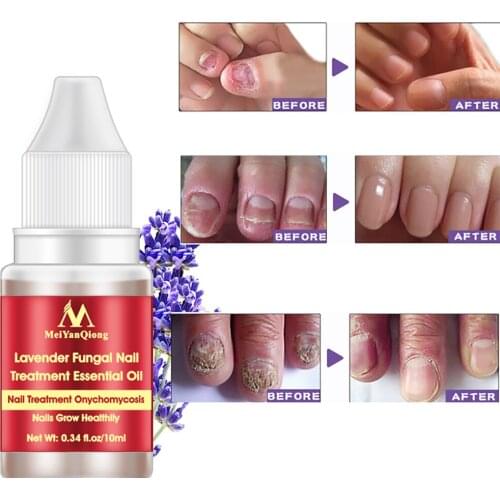 Lavender Nail Repair Essential Oil Anti Fungal Nail Treatment Remove Onychomycosis Nourishing Brighten Hand Foot Toes Nail Care