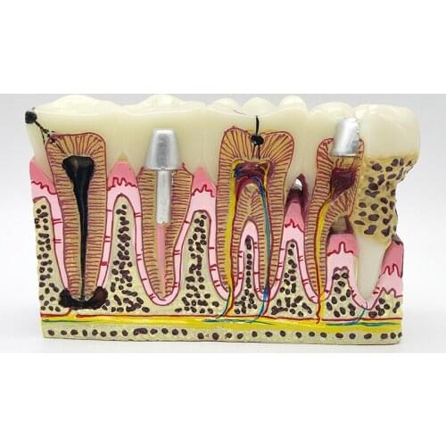 Dental teeth model common pathologies Anatomy of dental caries