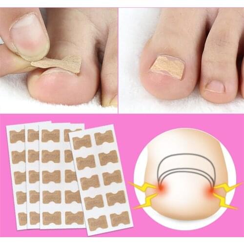 10PCS Nail Strips Anti-roll Nail Free Glue Toe Inlay Nail Corrector Patch Correction Stickers Special Toenails Care Foot Care