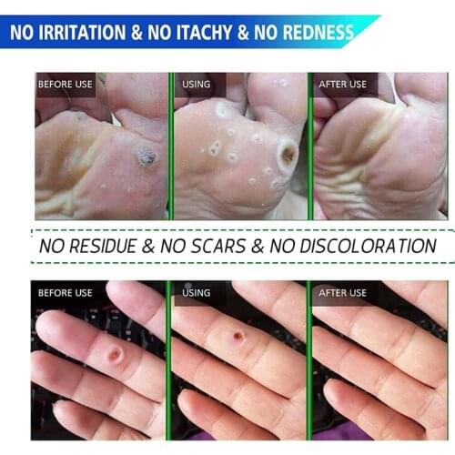 K0AE Corn Remover Pads, Remove Corns Fast, One Step Pads, Cushioning Protection Against Shoe Pressure, Release Feet