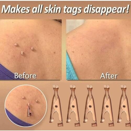 Wart Removal Clip Wart Remover Pointed Mouth Clip Skin Remover Pimple Acne Tool Face Clip Copper Tag Remover Remover Tag Y6Z2