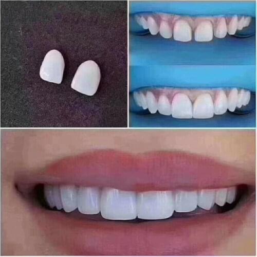 2Pcs No.31# Dental Veneers Whitening Ceramic Bright White LMS