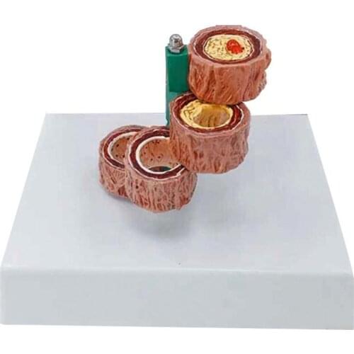 Blood Vessel human Hardening Of The Arteries Arteriosclerosis Model human Anatomical anatomy Model Medical supplies tools