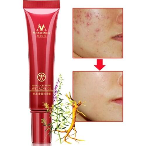 15g Effective Acne Removal Cream Herbal Anti-acne Repair Fade Acne Spots Oil Control Whitening Moisturizing Face Gel Skin Care
