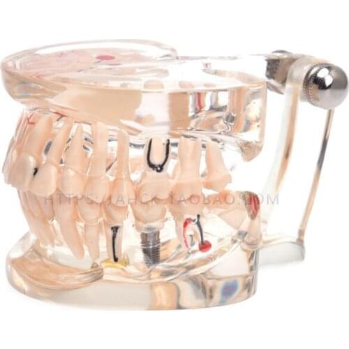 Teeth Model Dental implant Teaching Study With Restoration Bridge Tooth Dentist Medical Science Dental Disease Teaching Study