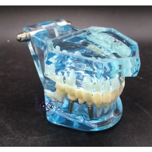 Dental educational model teeth Implants Pathology Models removable detal model