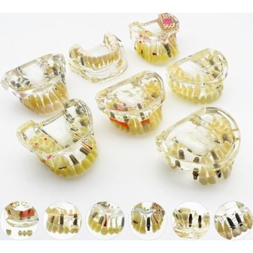 Dental Teeth model Implant With Bridge & Caries Dental Study Teach Dental implant model