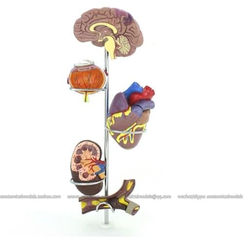 CMAM/12497 Heart-Human Hypertension Model, Human Heart Medical Teaching Anatomical Model