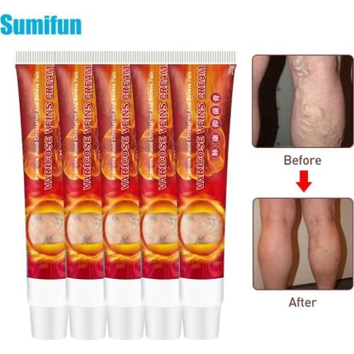 Sumifun 5pcs Varicose Veins Miracle Cream Varicosity Angiitis Remedy Ointment Relief Veins Pain Phlebitis Spider legs D3176