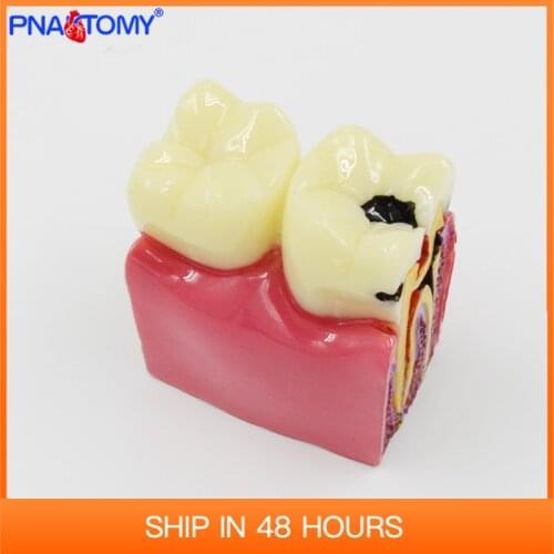 Dental Materials Lab Teeth Model 6 Times Caries Comparation Study Models For Dentist Studying and Researching