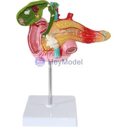 HeyModel Anatomical model of kidney disease Nephropathy model Nephrology Urology Surgical model Kidney pathology