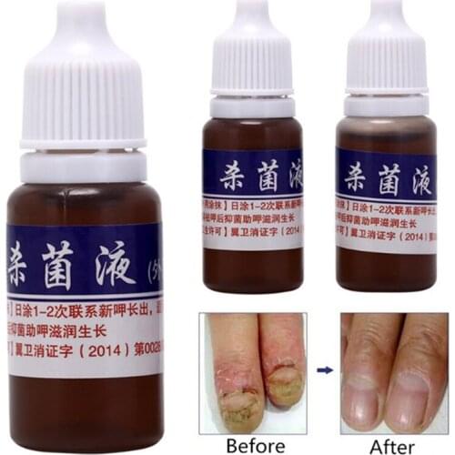 Anti Infection Fungal Nail Treatment Liquid Foot Care Essence Whitening Toe Nail Fungus Removal Gel Paronychia Onychomycosis