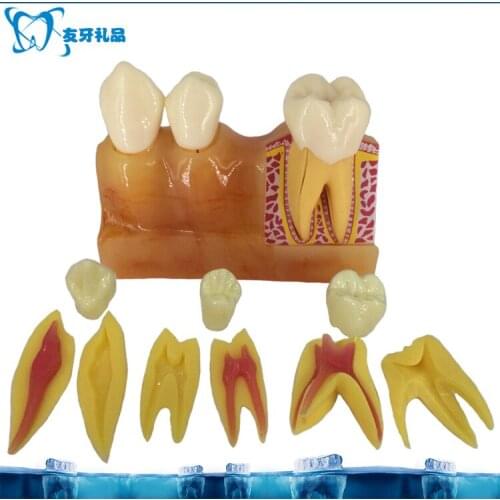 4 Times Tooth Decomposition Resin Model Dental Pulp and Anatomical Oral Cavity Model Teaching Explanation