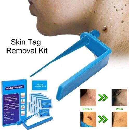 Medical Non Toxic Skin tag remover tool Adult Mole wart treatment body skin care tools set With Cleansing Swabs Home Use