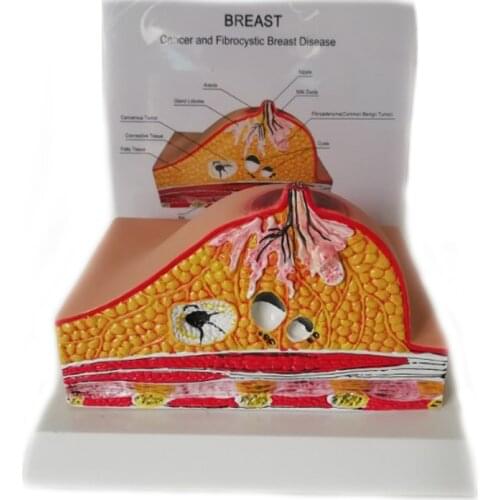 1:1 Median Section of Human Female Breast Pathology Anatomy Model Breast Lesion Model Lactating Breasts Anatomy Teaching Supply